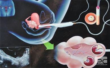 男性因素案例
